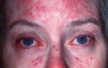 Hogyan kell kezelni rosacea az arc az okok, tünetek, hardver technikákat, gyógyszereket, az emberek