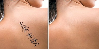 Ennek csökkentése tetoválás otthon népi jogorvoslati