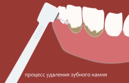 Hogyan lehet eltávolítani a fogkő fogorvosi többet megtudni a módszerek a tisztítás! (Stone) Hogyan lehet eltávolítani a fogkő fogorvosi többet megtudni a módszerek a tisztítás!
