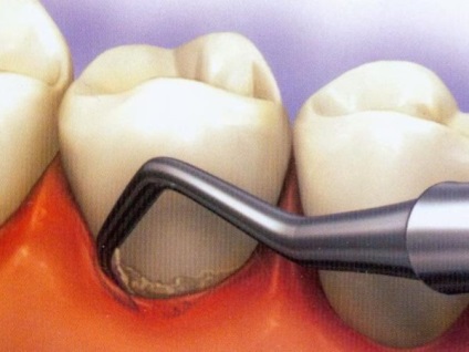 Hogyan lehet eltávolítani a fogkő fogorvosi többet megtudni a módszerek a tisztítás!