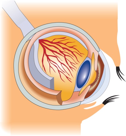 Hogyan lehet gyógyítani glaucoma műtét nélkül, mintegy szembetegség