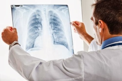 Candidiasis pulmonális okai, tünetei és milyen gyorsan gyógyulnak
