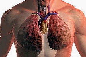 Candidiasis pulmonális tünetek, okok, szövődmények