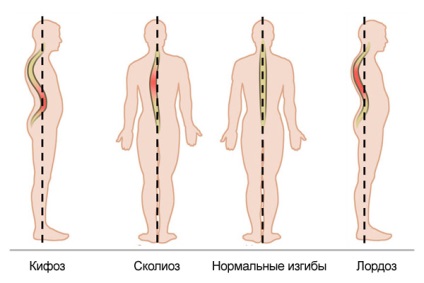 Kyphosis, lordosis és gerincferdülés a gerinc