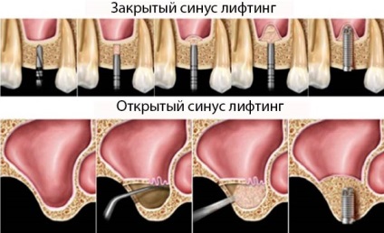 Csontpótlás csontszövet atrophia, csontpótlás technikák