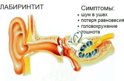 Labyrinthitis - okai, tünetei, tünetek és kezelés