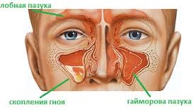 Heal lor betegségek (mandulagyulladás, rhinitis, sinusitis) lézer