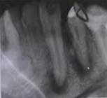 A kezelés a marginális periodontitis - studopediya