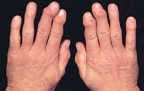 A kezelés népi jogorvoslati rheumatoid arthritis - befolyása kábítószer-díjat starinnyeretsepty