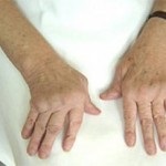 Az osteoarthritis kezelésére a kéz és az ujjak ízületek