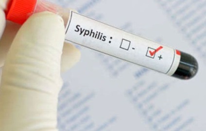 Szifilisz ceftriaxon kezelés rendszerek, következményei és a megelőzés