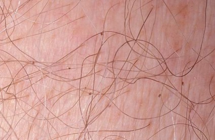 Szemérem tetvek otthoni kezelés, hatékony kezelés otthon (okozott betegség ágyéki) Szemérem tetvek otthoni kezelés, hatékony kezelés otthon