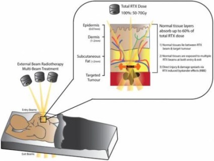 Sugárterápia torok rák - különösen olyan módszerekre