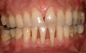 A marginális parodontitis és annak kezelése