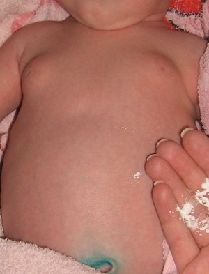 Mastitis újszülött fiúk és lányok, tünetei és kezelése gennyes tőgygyulladás