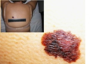 Melanoma a bőr tünetek, okok, megelőzés és a kezelés