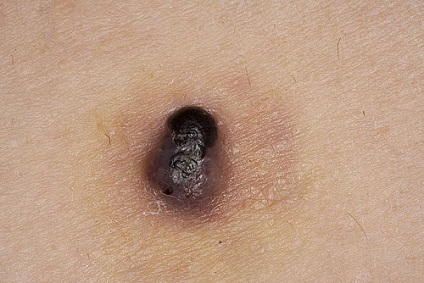 Melanoma a bőr tünetek, okok, megelőzés és a kezelés