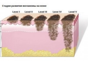 Melanoma a bőr tünetek, okok, megelőzés és a kezelés