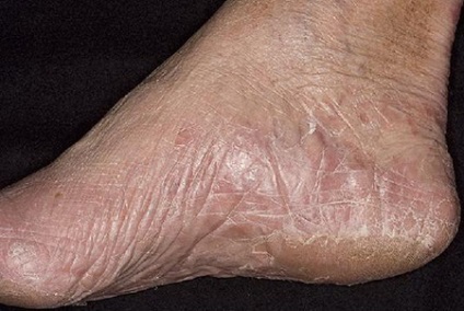 Mycosis a láb és a kéz a tünetek és a kezelés a bőr a láb gombás betegségek