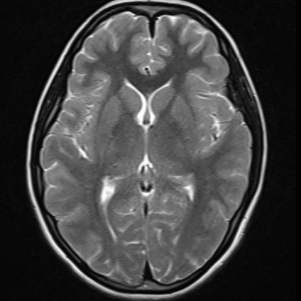 MRI az agy sugárzás diagnózis