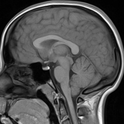 MRI az agy sugárzás diagnózis