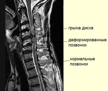 gerinc MRI, amely azt mutatja, hogy az eljárás