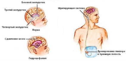 Kültéri agy hydrocephalus felnőtteknél - kezelés gyógyszeres, konzervatív és