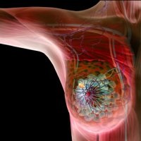 Infúziós gomba a rák - szike - orvosi információk és oktatási portál