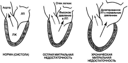 Mitrális billentyű elégtelenség 1, 2, 3 és 4 fok a kezelés, prognózis, a tünetek (mitrális billentyű-elégtelenségben diagnosztika) Mitrális billentyű elégtelenség 1, 2, 3 és 4 fok a kezelés, prognózis, a tünetek