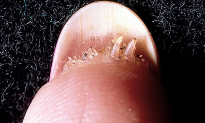 Szemölcsök a körmök alatt - Amely parazita pinwormok