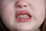 Ortotik fajtái és jellemzői, jelzések, működési mód, a hatékonyság (ortotik fotó) Ortotik fajtái és jellemzői, jelzések, működési mód, a hatékonyság