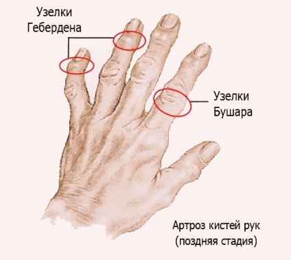 Osteoarthritis a kezek