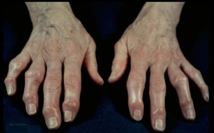 Osteoarthritis a kezek