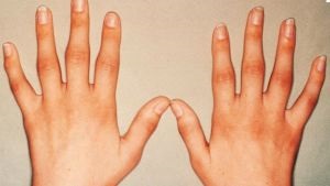 Osteoarthritis ujjak és a kéz tünetek kezelésére a népi és a hagyományos média