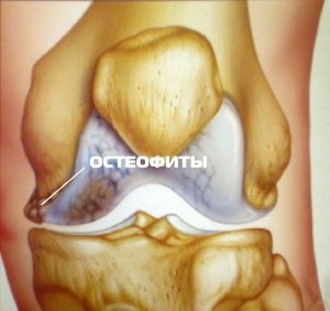 Osteophytes kezelés népi jogorvoslati csontdefektusok