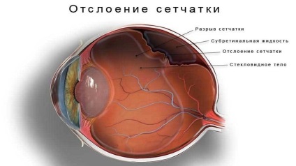OTSZ Online - Diabéteszes retinopátia elleni injekció