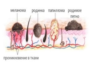 Papilloma fül-e a félelem, diagnózis és kezelés