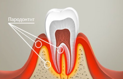 A periodontitis gyermekeknél okoz, formái, a betegség kezelésében