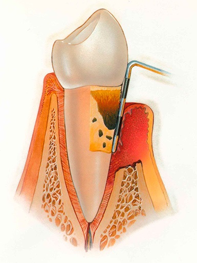 A periodontitis gyermekeknél - Okok, típusai és a periodontális betegség kezelésére gyermekeknél
