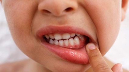 A periodontitis gyermekeknél - Okok, típusai és a periodontális betegség kezelésére gyermekeknél