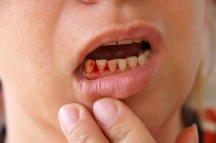 A periodontitis gyermekek okoz és kezelési eljárások (oka) A periodontitis gyermekeknél okoz és kezelési eljárások