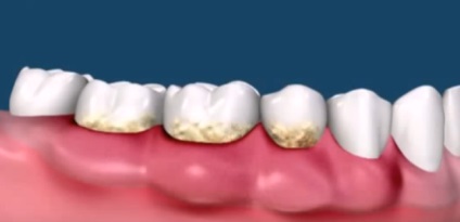A periodontitis gyermekek okoz és kezelési eljárások (oka) A periodontitis gyermekeknél okoz és kezelési eljárások