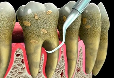 A periodontitis gyermekek tünetei, kezelése és megelőzése