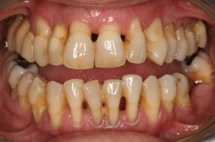 A periodontális betegség (gumi) betegség okoz, a tünetek, a kezelés