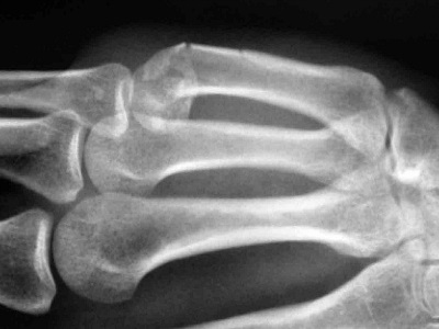 5 Fracture lábközépcsont csont a láb, mint séta öntött helyreállítása, tünetei és kezelése