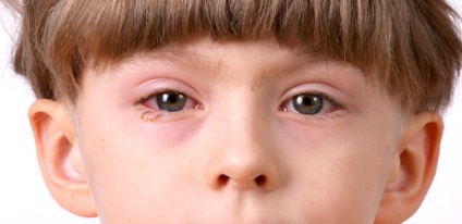 Elsősegélynyújtás allergiás reakciók