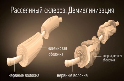 Étkezés sclerosis multiplexben szenvedő betegek diétás, menük, receptek, vélemények az orvosok