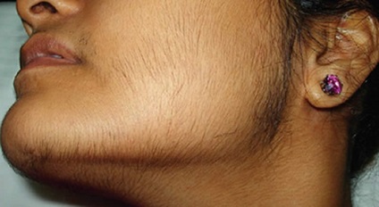 Miért nő nőnek egy szakállas okai hirsutism