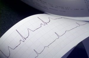 Megfelelő dekódolását EKG