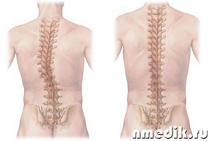 Megelőzése scoliosis és degeneratív betegség lemez